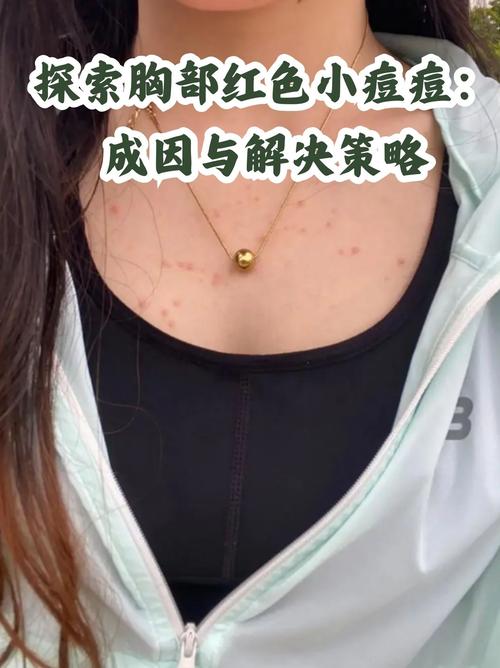 孕期胸前长痘痘是激素变化还是皮肤问题?-第1张图片-中州医学会 孕期胸前长痘痘是激素变化还是皮肤问题?-第1张图片-中州医学会