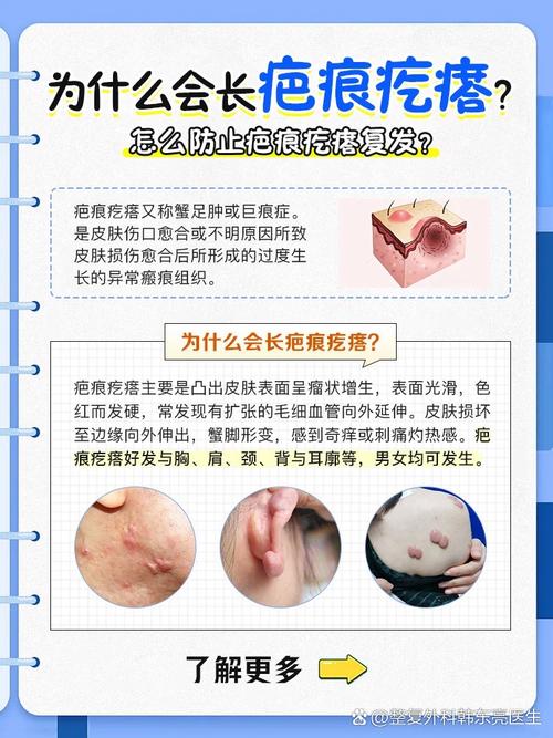 孕期胸前长痘痘是激素变化还是皮肤问题?-第3张图片-中州医学会 孕期胸前长痘痘是激素变化还是皮肤问题?-第3张图片-中州医学会