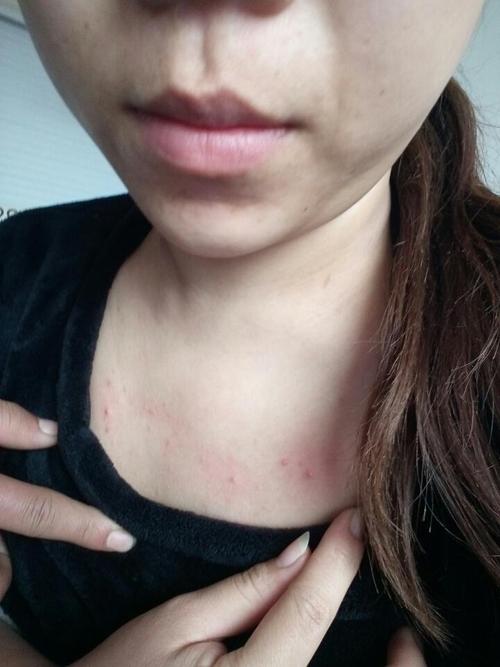 孕期胸前长痘痘是激素变化还是皮肤问题?-第2张图片-中州医学会 孕期胸前长痘痘是激素变化还是皮肤问题?-第2张图片-中州医学会