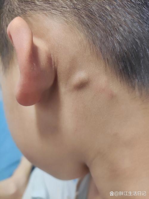 儿童淋巴结长期不消，是严重问题吗？-第3张图片-中州医学会