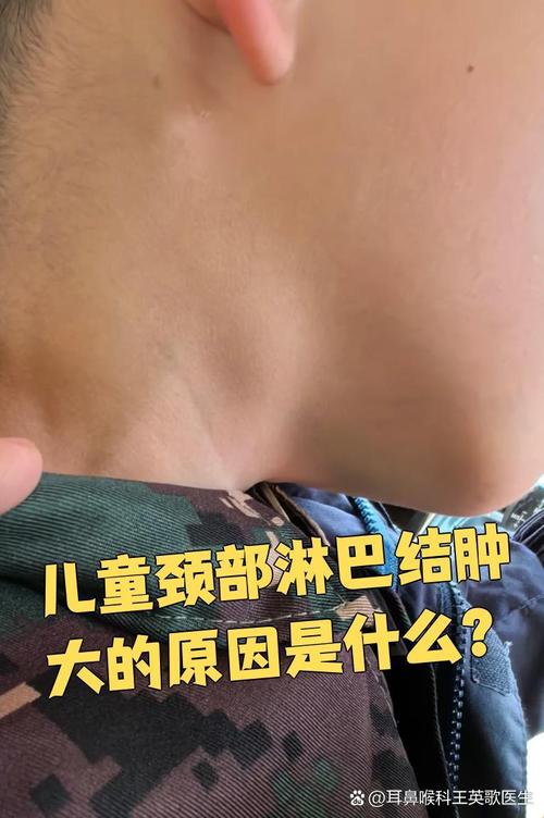 儿童淋巴结长期不消，是严重问题吗？-第1张图片-中州医学会