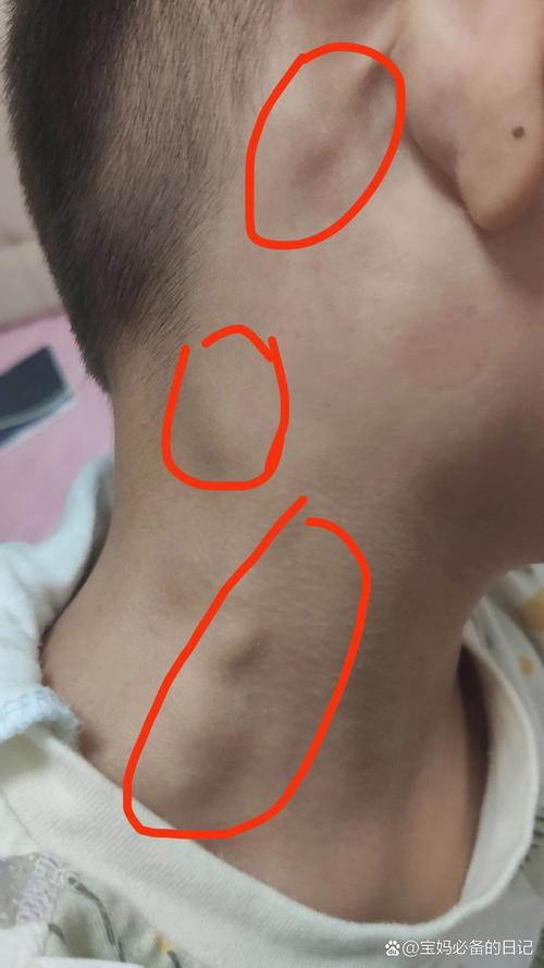 儿童淋巴结长期不消，是严重问题吗？-第2张图片-中州医学会