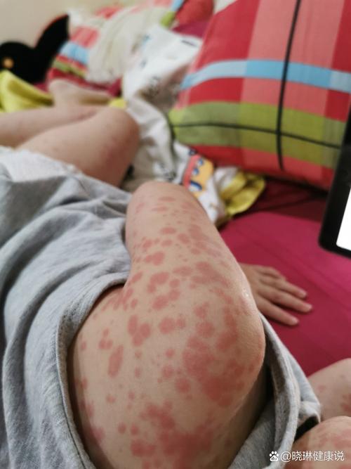 新生儿被蚊子咬红点怎么办？图片需警惕什么？-第2张图片-中州医学会