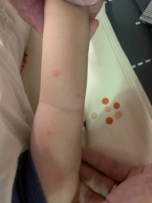 新生儿被蚊子咬红点怎么办？图片需警惕什么？-第1张图片-中州医学会