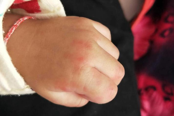 新生儿被蚊子咬红点怎么办？图片需警惕什么？-第3张图片-中州医学会