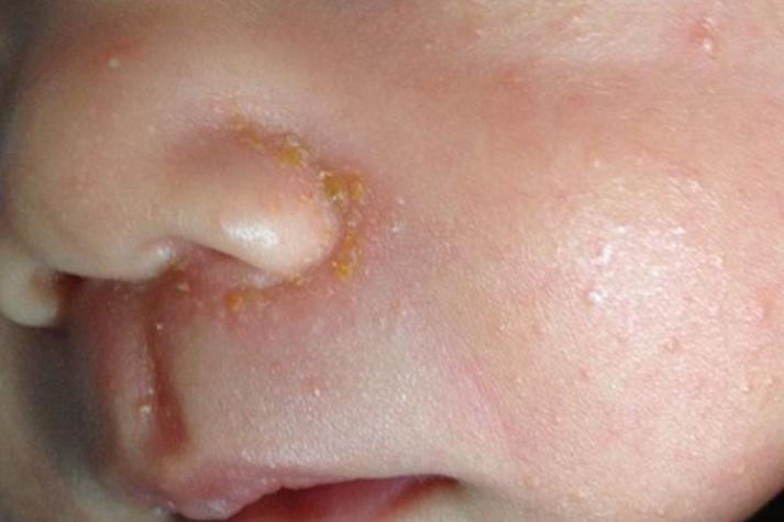 新生儿鼻子黄点点是啥？-第1张图片-中州医学会