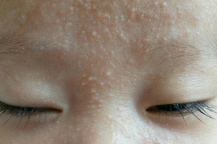 新生儿鼻子黄点点是啥？-第2张图片-中州医学会