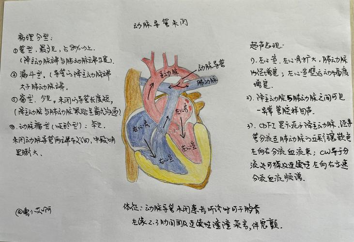 新生儿动脉导管何时能自然闭合？-第2张图片-中州医学会