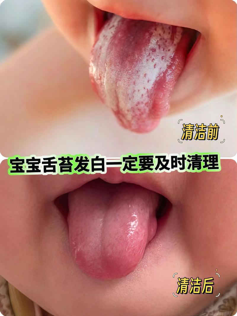 新生儿需清洁口腔舌苔吗？-第2张图片-中州医学会