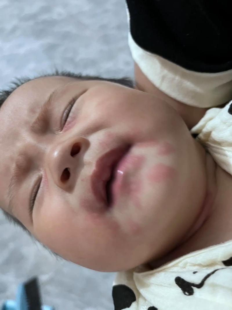 新生儿奶粉过敏有哪些症状？-第3张图片-中州医学会