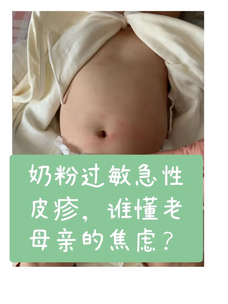 新生儿奶粉过敏有哪些症状？-第2张图片-中州医学会