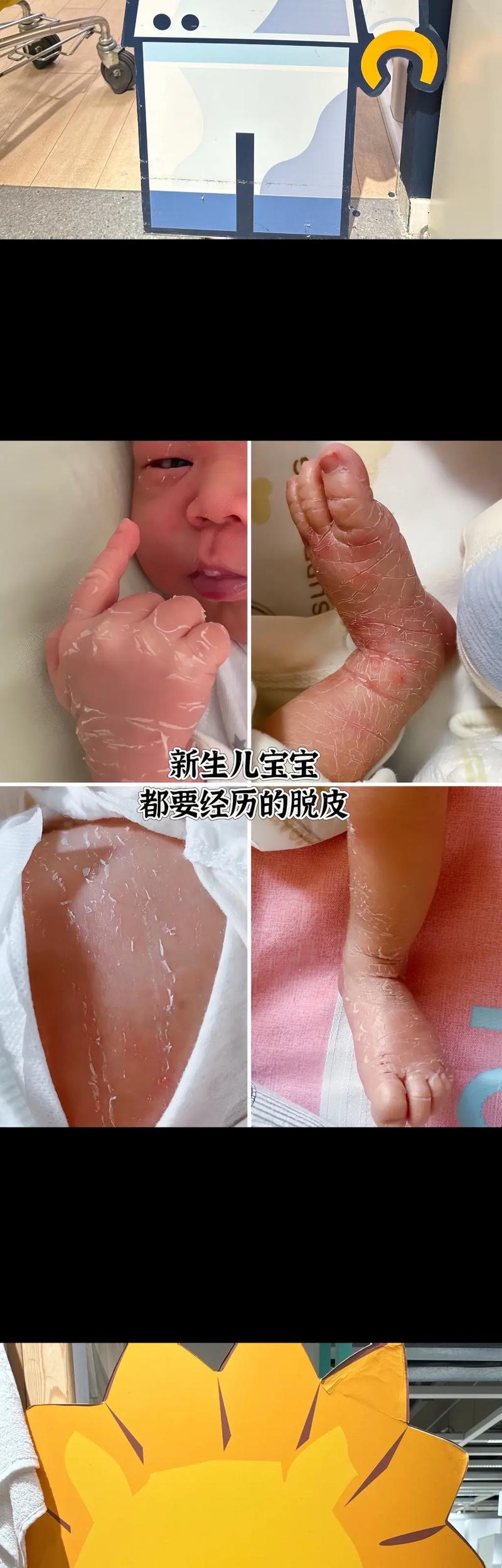 新生儿皮肤啥时候能变白？-第2张图片-中州医学会