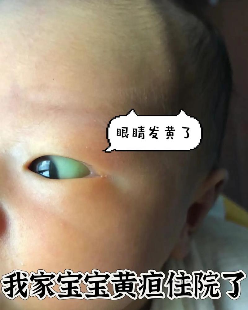 新生儿眼黄必是严重黄疸吗？-第2张图片-中州医学会