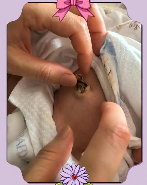 脐带脱落后还需继续消毒吗？-第2张图片-中州医学会