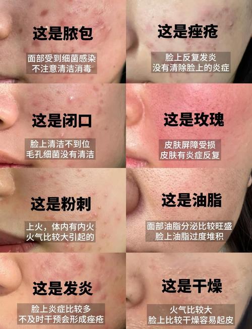 孕期为何长痘？激素变化还是其他原因？-第3张图片-中州医学会