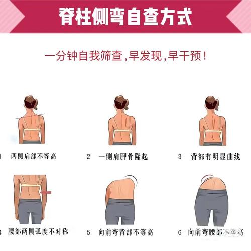 10岁儿童脊柱侧弯怎么办？-第3张图片-中州医学会