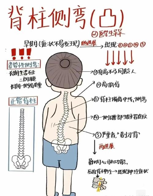 10岁儿童脊柱侧弯怎么办？-第1张图片-中州医学会