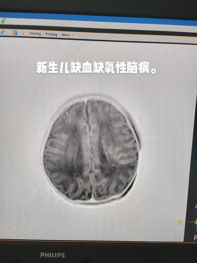 新生儿缺氧缺血性脑病后遗症-第2张图片-中州医学会