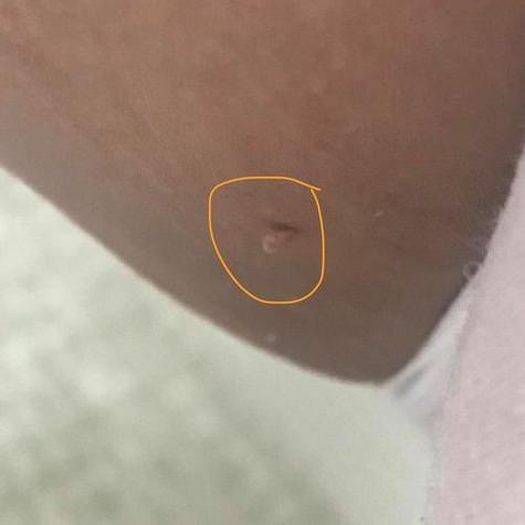 孕期乳晕小肉粒是何原因？-第2张图片-中州医学会