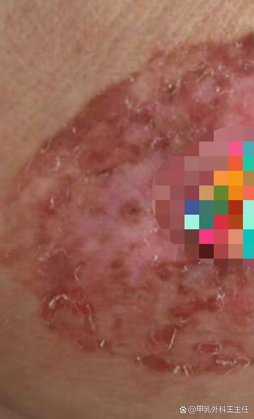 孕期乳晕小肉粒是何原因?-第1张图片-中州医学会 孕期乳晕小肉粒是何原因?-第1张图片-中州医学会