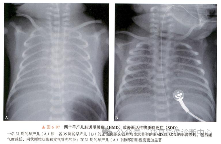 新生儿肺透明膜病有哪些典型临床表现？-第1张图片-中州医学会