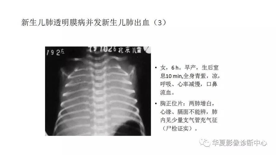 新生儿肺透明膜病有哪些典型临床表现？-第3张图片-中州医学会