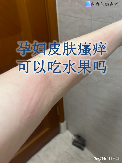 孕期腿痒怎么办?-第2张图片-中州医学会 孕期腿痒怎么办?-第2张图片-中州医学会