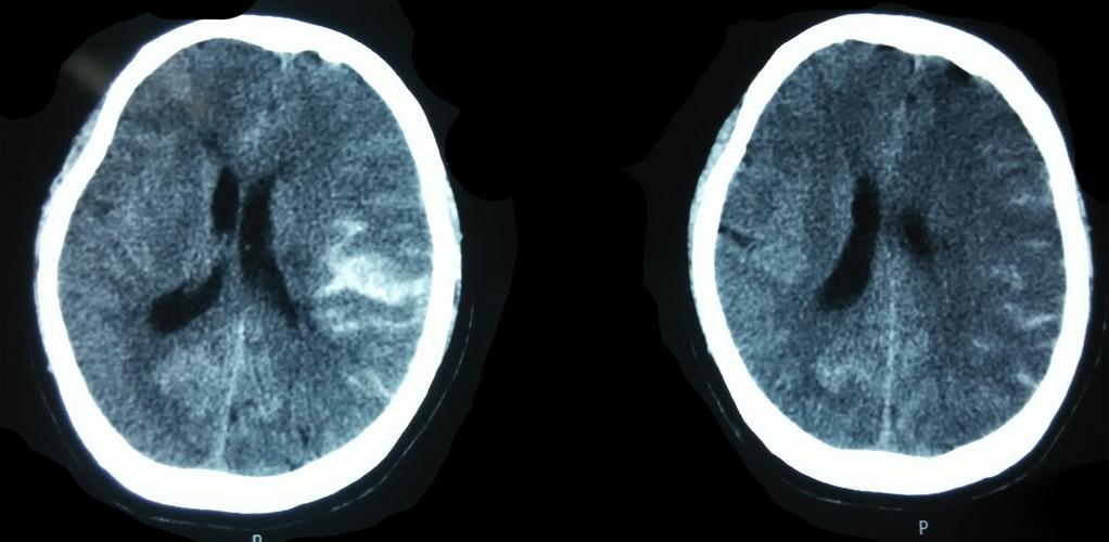 新生儿蛛网膜下腔出血后遗症能治愈吗？-第2张图片-中州医学会