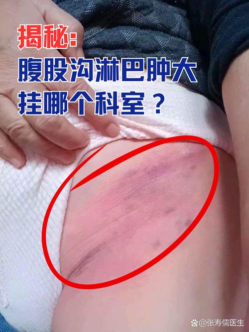 儿童腹腔淋巴结肿大，咋办？-第1张图片-中州医学会