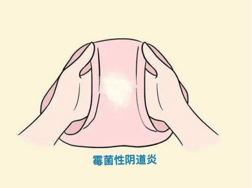 孕期阴道异味是何原因导致？-第1张图片-中州医学会