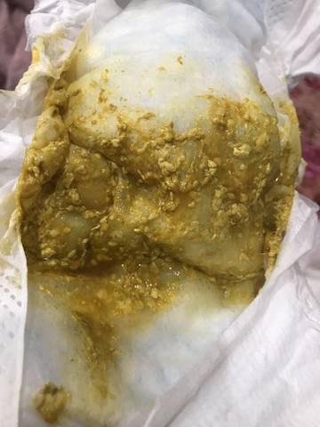 新生儿拉黄屎带奶瓣正常吗？-第3张图片-中州医学会