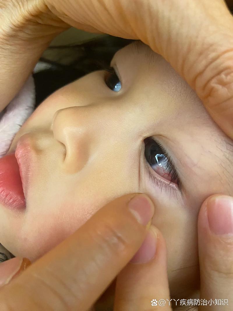 新生儿眼红血丝正常吗？-第2张图片-中州医学会