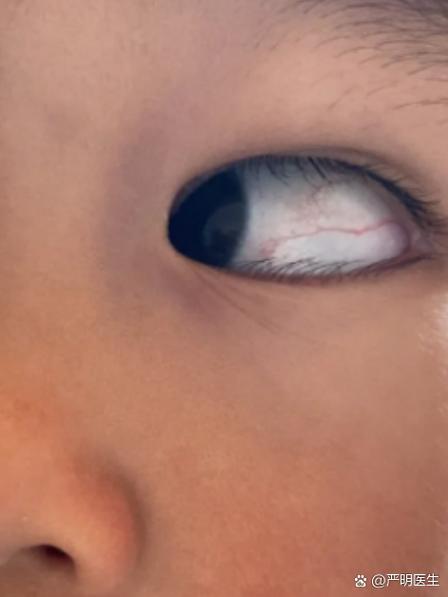 新生儿眼红血丝正常吗？-第3张图片-中州医学会