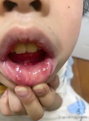 儿童口腔溃疡能用西瓜霜吗？-第3张图片-中州医学会