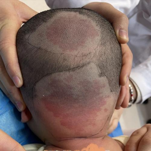 新生儿斑痣和鲜红斑痣有何不同？-第2张图片-中州医学会