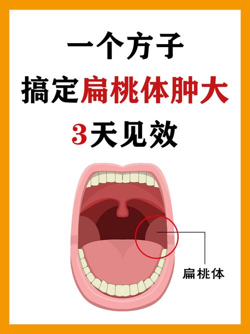 儿童慢性扁桃体炎怎么根治-第3张图片-中州医学会