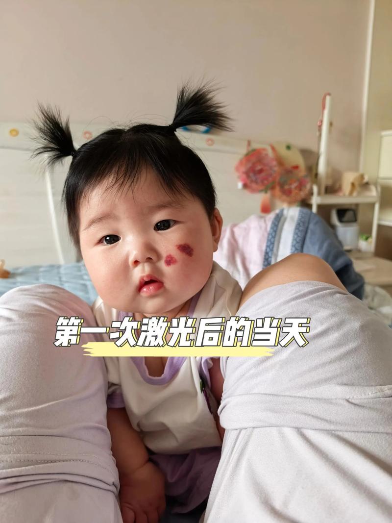 新生儿鲜红斑痣能自行消退吗？-第2张图片-中州医学会