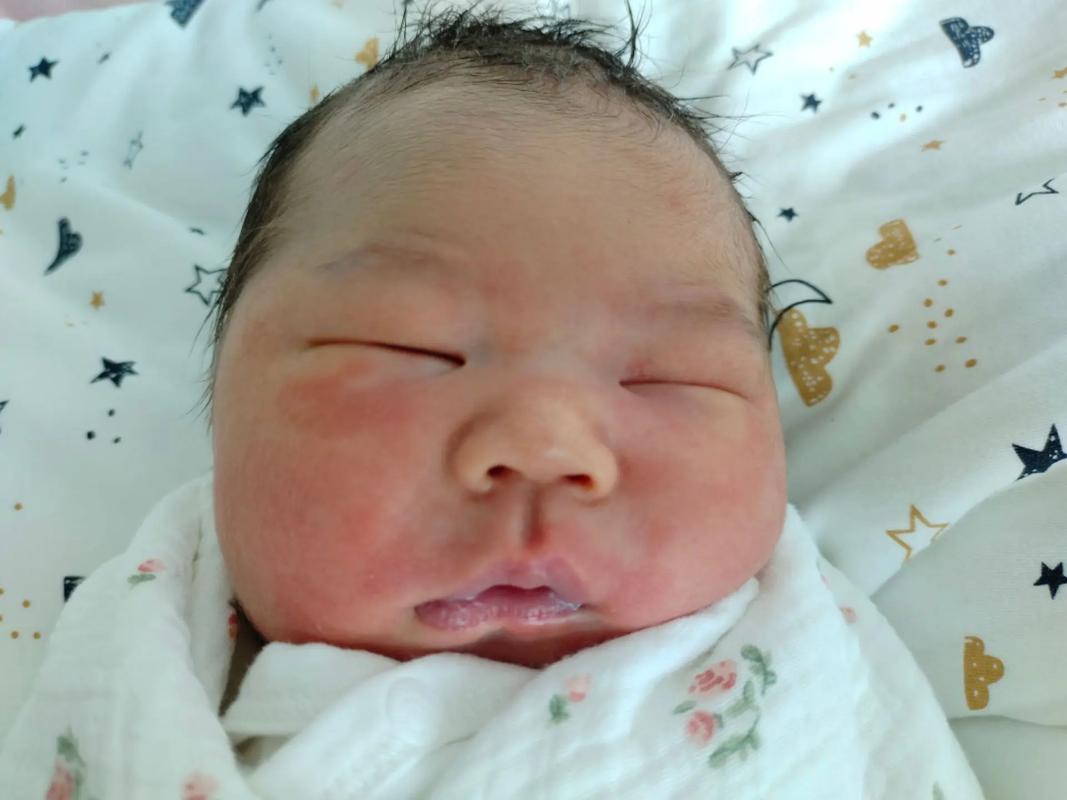 新生儿鲜红斑痣能自行消退吗？-第1张图片-中州医学会