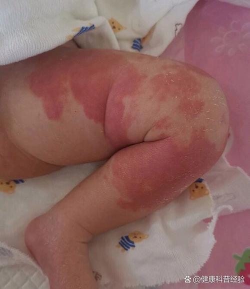 新生儿鲜红斑痣能自行消退吗？-第3张图片-中州医学会