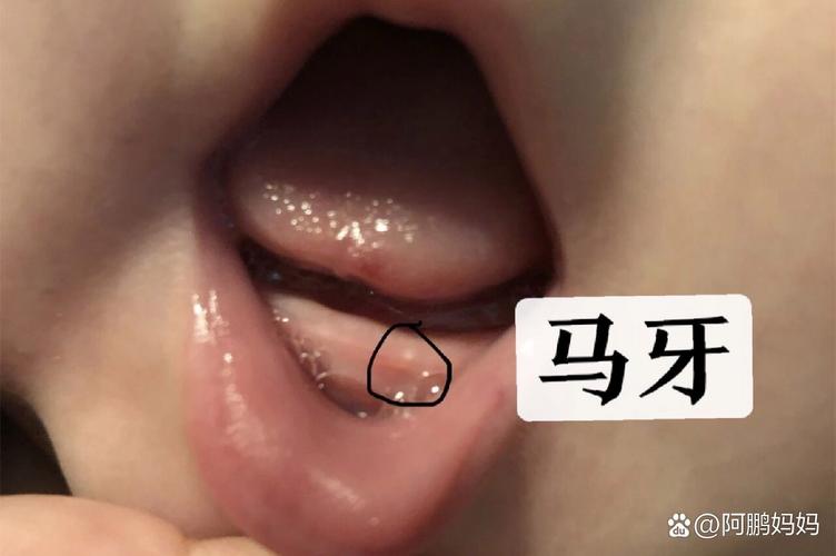 新生儿牙龈上的白东西是什么-第1张图片-中州医学会