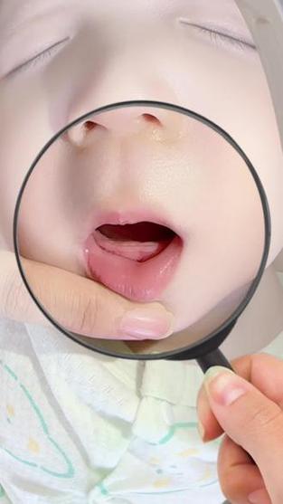 新生儿牙龈上的白东西是什么-第3张图片-中州医学会