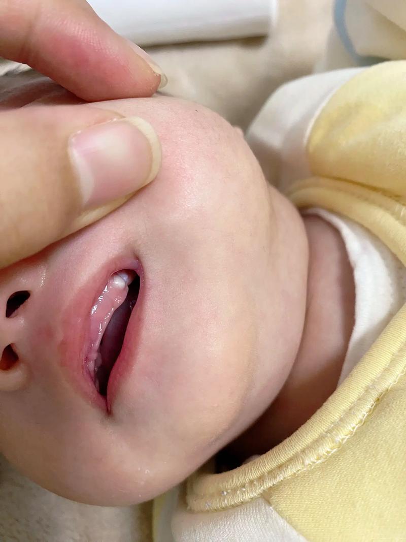 新生儿牙龈上的白东西是什么-第2张图片-中州医学会