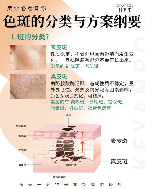 儿童雀斑因何而起?-第3张图片-中州医学会 儿童雀斑因何而起?-第3张图片-中州医学会