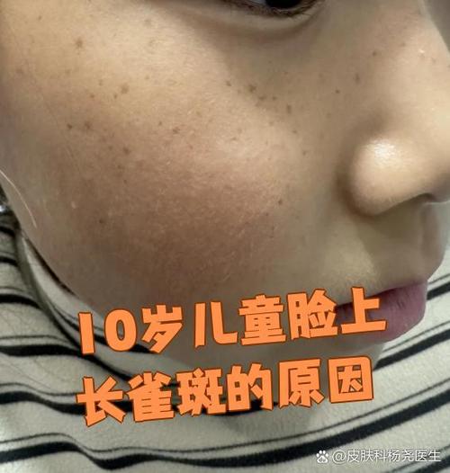 儿童雀斑因何而起?-第2张图片-中州医学会 儿童雀斑因何而起?-第2张图片-中州医学会