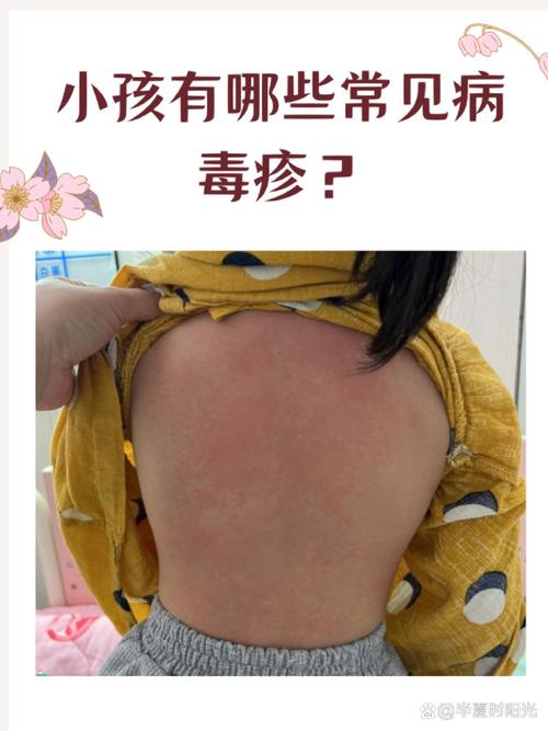 儿童免疫系统疾病早期症状-第1张图片-中州医学会 儿童免疫系统疾病早期症状-第1张图片-中州医学会