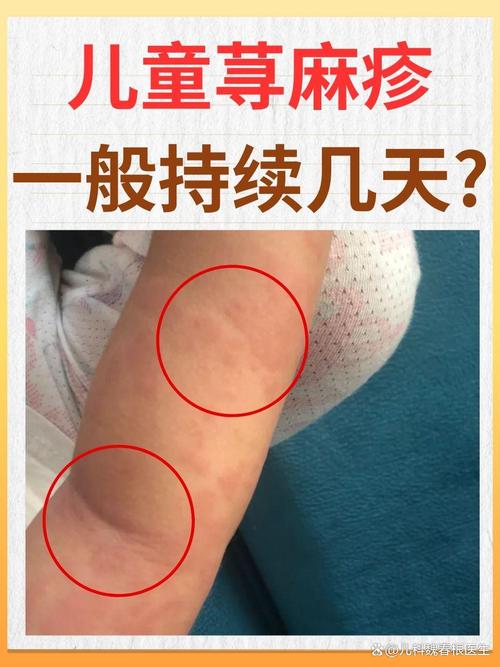 儿童免疫系统疾病早期症状-第3张图片-中州医学会 儿童免疫系统疾病早期症状-第3张图片-中州医学会