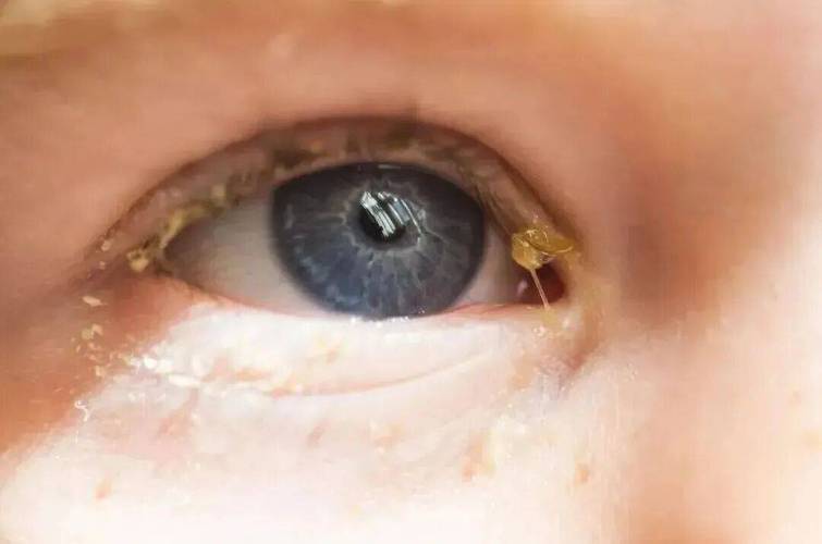 新生儿眼屎多怎么办？需清理或就医？-第2张图片-中州医学会