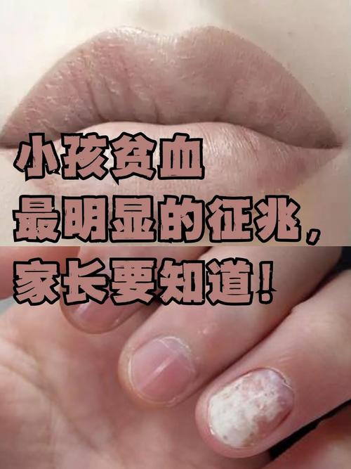 儿童血象高有哪些症状表现？-第3张图片-中州医学会