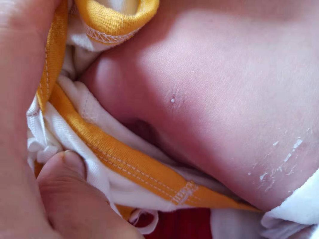 新生儿乳头白点是何原因？-第3张图片-中州医学会