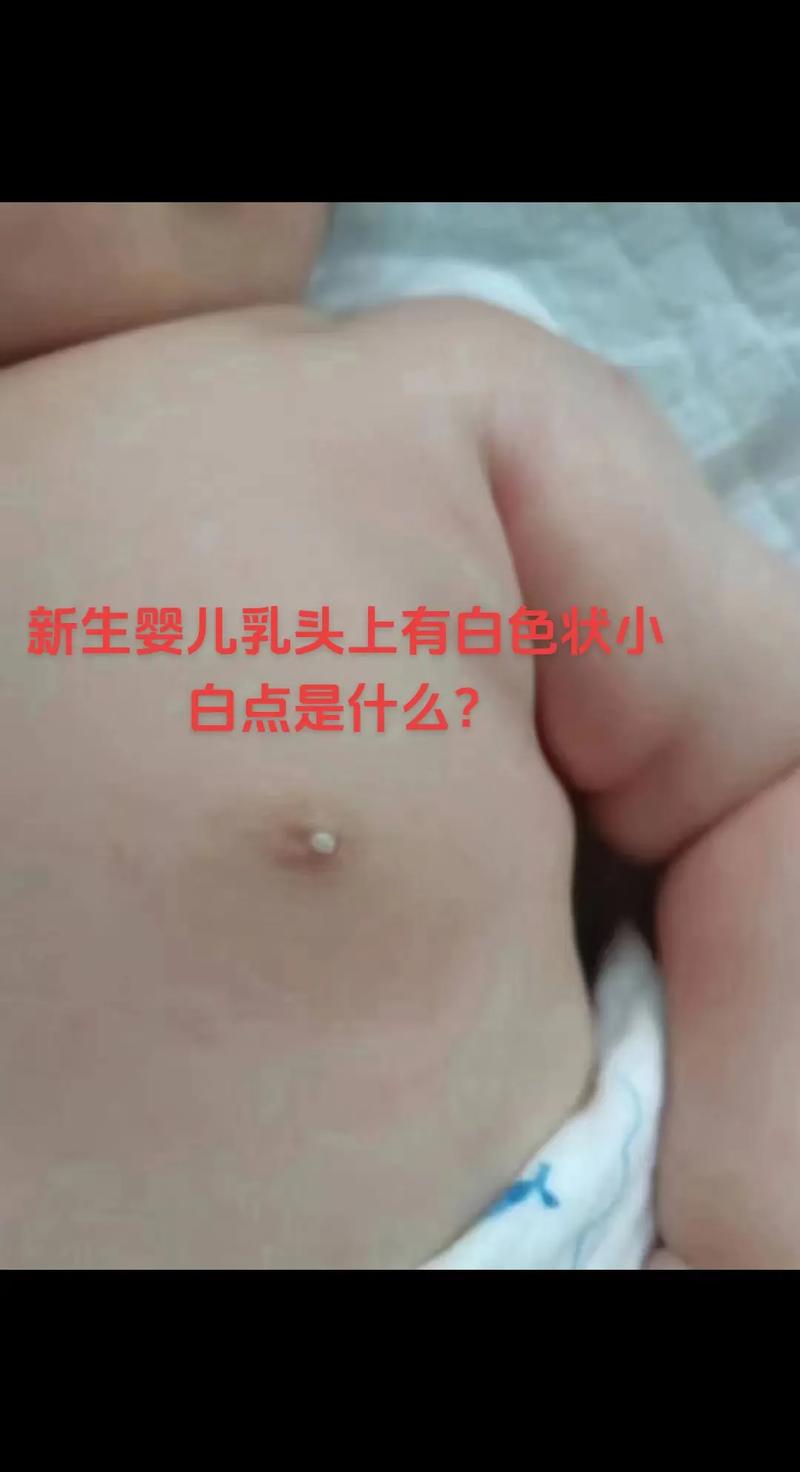 新生儿乳头白点是何原因？-第1张图片-中州医学会